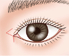手順01：Z型に皮弁をデザインします。